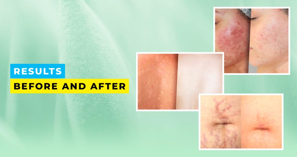Results Before and After